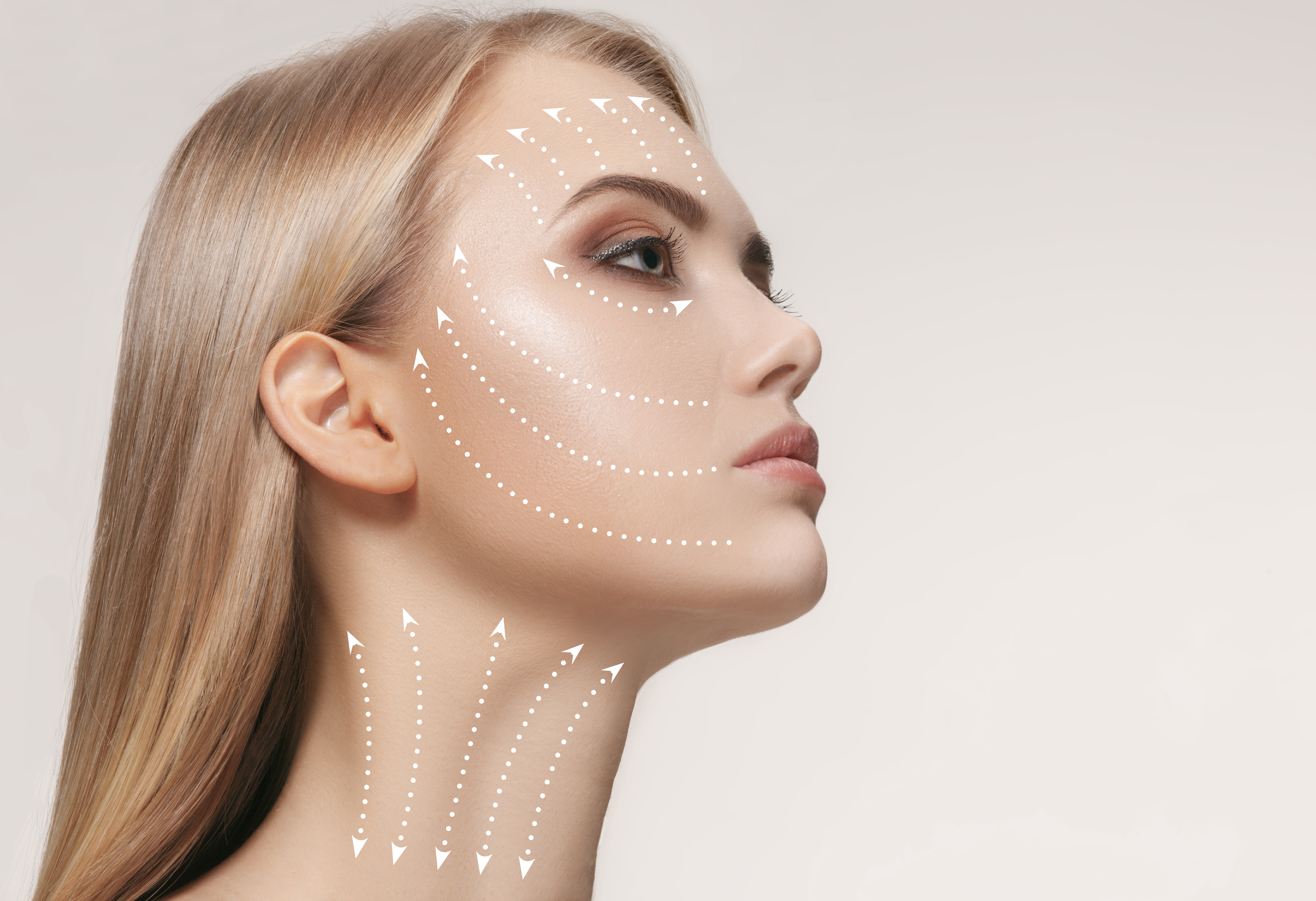 Auf dem Gesicht einer Frau sind Linien eingezeichnet, wo dank HIFU (Medical hochfokussierte Ultraschalltherapie) Falten reduziert werden können.